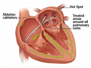Miami-Dade County heart surgery
